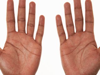 Aşırı el terlemesinin tedavisi mümkün